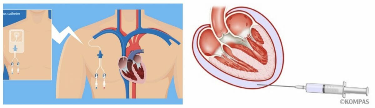 中心静脈カテーテルの挿入(左図)や、心臓周囲に貯留した液体（右図の水色部分）の穿刺吸引をエコーを利用することで安全に行える　出展：慶応義塾大学病院 KOPMAS
